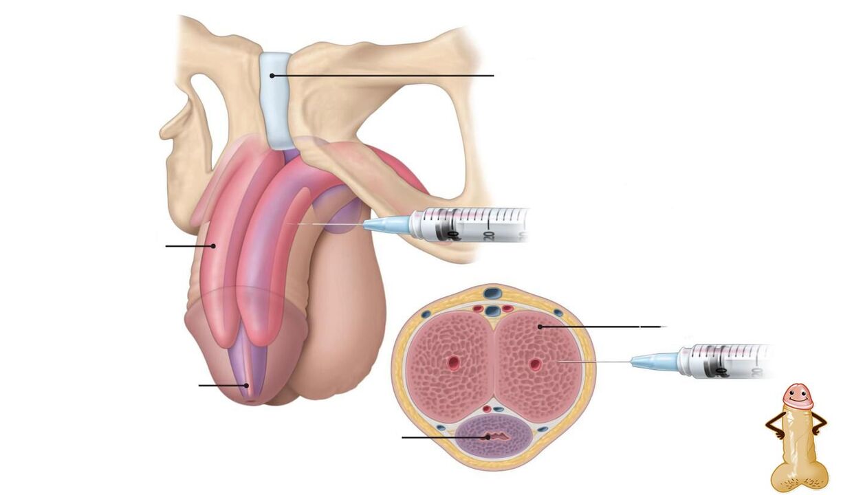 hyaluronic acid injection for penis enlargement
